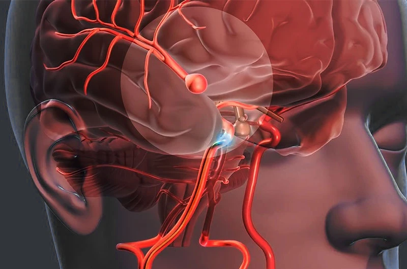 Médico analisando ressonância magnética do cérebro em avaliação de aneurisma cerebral em Piracicaba
